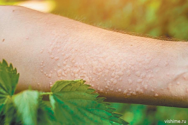 Аллергия на крапиву